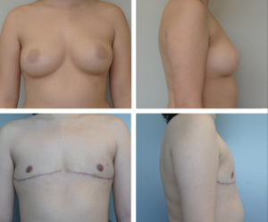 Top Surgery Portland Oregon by Dr. Tina Jenq 